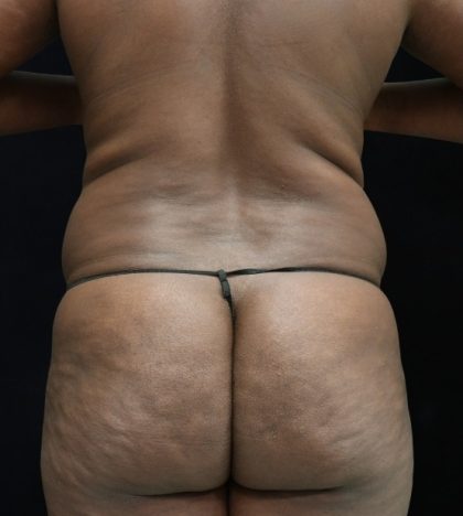 Liposuction Before & After Patient #11544