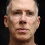 Levinelift Before & After Patient #11789