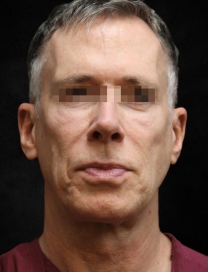 Levinelift Before & After Patient #11789