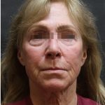 Levinelift Before & After Patient #11790