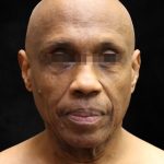 Levinelift Before & After Patient #11792