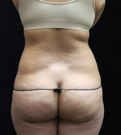 Liposuction Before & After Patient #11540