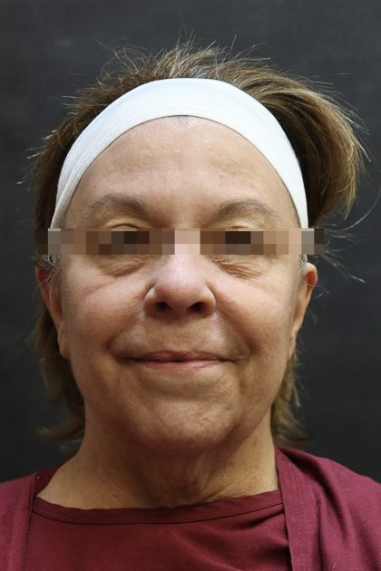Levinelift Before & After Patient #11791