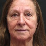 Levinelift Before & After Patient #11793
