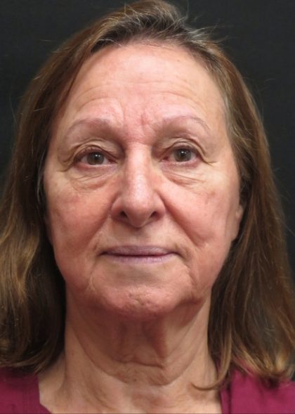 Levinelift Before & After Patient #11793