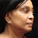 Levinelift Before & After Patient #11819