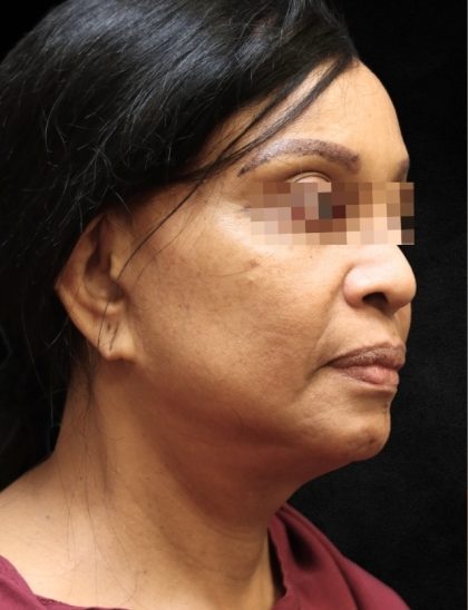 Levinelift Before & After Patient #11819