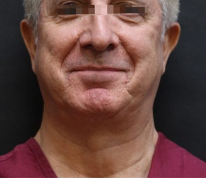 Levinelift Before & After Patient #11824