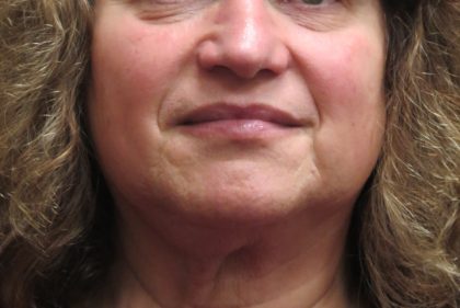 Levinelift Before & After Patient #11825