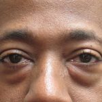 Eyelid Surgery Before & After Patient #11890