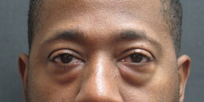 Eyelid Surgery Before & After Patient #11890