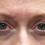 Eyelid Surgery Before & After Patient #11891