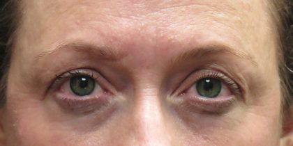Eyelid Surgery Before & After Patient #11891