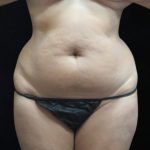 Liposuction Before & After Patient #11545