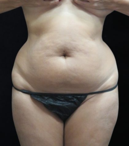 Liposuction Before & After Patient #11545