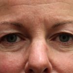 Eyelid Surgery Before & After Patient #11892