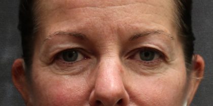 Eyelid Surgery Before & After Patient #11892