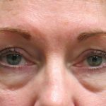 Eyelid Surgery Before & After Patient #11893