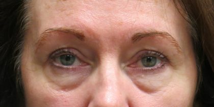 Eyelid Surgery Before & After Patient #11893