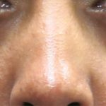 Eyelid Surgery Before & After Patient #11894