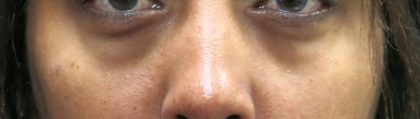 Eyelid Surgery Before & After Patient #11894