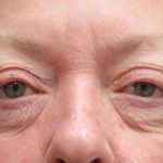 Eyelid Surgery Before & After Patient #11895