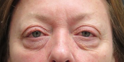 Eyelid Surgery Before & After Patient #11895