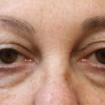 Eyelid Surgery Before & After Patient #11896
