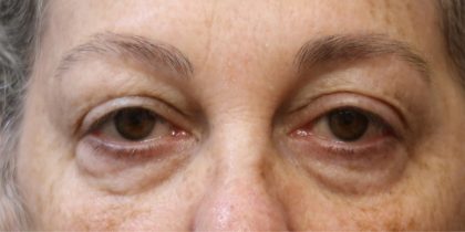 Eyelid Surgery Before & After Patient #11896