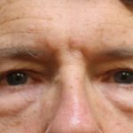 Eyelid Surgery Before & After Patient #11897