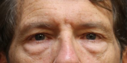 Eyelid Surgery Before & After Patient #11897