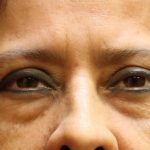 Eyelid Surgery Before & After Patient #11898
