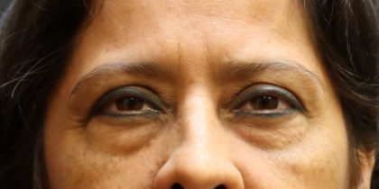 Eyelid Surgery Before & After Patient #11898