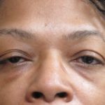 Eyelid Surgery Before & After Patient #11899