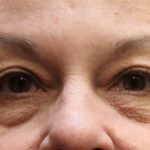 Eyelid Surgery Before & After Patient #11900