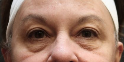 Eyelid Surgery Before & After Patient #11900