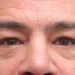Eyelid Surgery Before & After Patient #11901