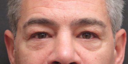 Eyelid Surgery Before & After Patient #11901