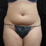 Liposuction Before & After Patient #11546