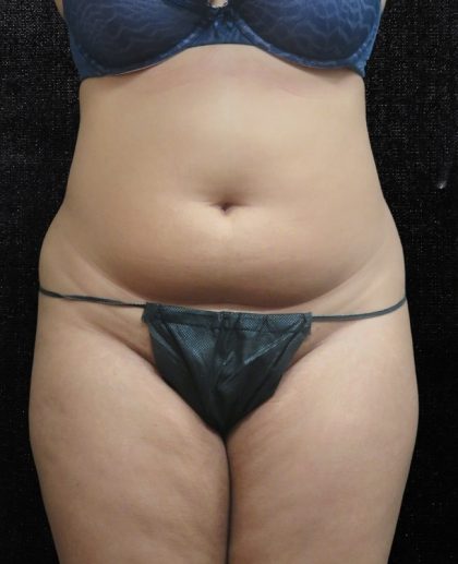 Liposuction Before & After Patient #11546