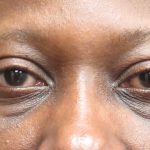Eyelid Surgery Before & After Patient #11902