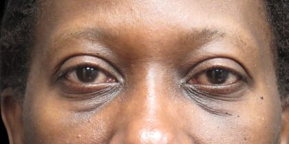 Eyelid Surgery Before & After Patient #11902