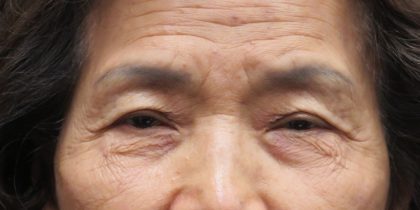 Eyelid Surgery Before & After Patient #11903