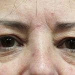 Eyelid Surgery Before & After Patient #11904