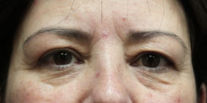Eyelid Surgery Before & After Patient #11904