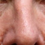 Eyelid Surgery Before & After Patient #11905