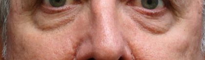 Eyelid Surgery Before & After Patient #11905