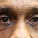Eyelid Surgery Before & After Patient #11906