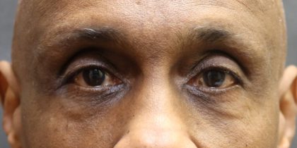Eyelid Surgery Before & After Patient #11906