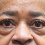 Eyelid Surgery Before & After Patient #11907